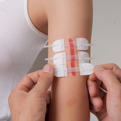 医用 无针皮肤缝合器 医用胶带 皮肤减张器免缝针拉扣 免缝胶带